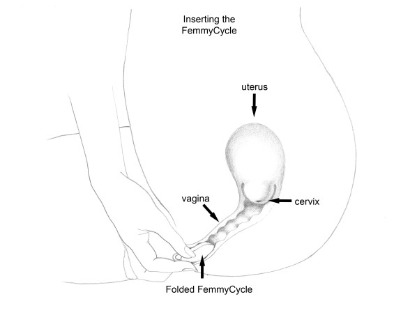 Inserting the FemmyCycle