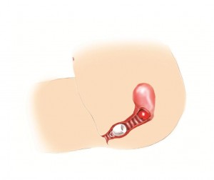 Inserting a menstrual cup femmycycle insertion